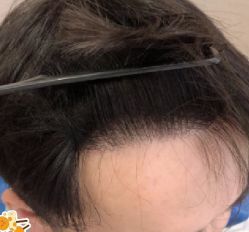 -大麦微针植发丨全国连锁