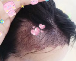 -大麦微针植发全国连锁