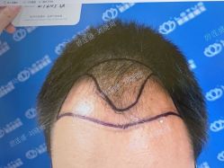 -碧莲盛·不剃发植发