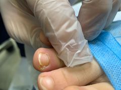 -Andrew指甲专科灰指甲·甲沟炎矫正·3D步态矫形鞋垫定制(浦三路店)