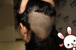 点击看大图 -大麦微针植发丨全国连锁