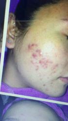 -蕾特恩专业祛痘