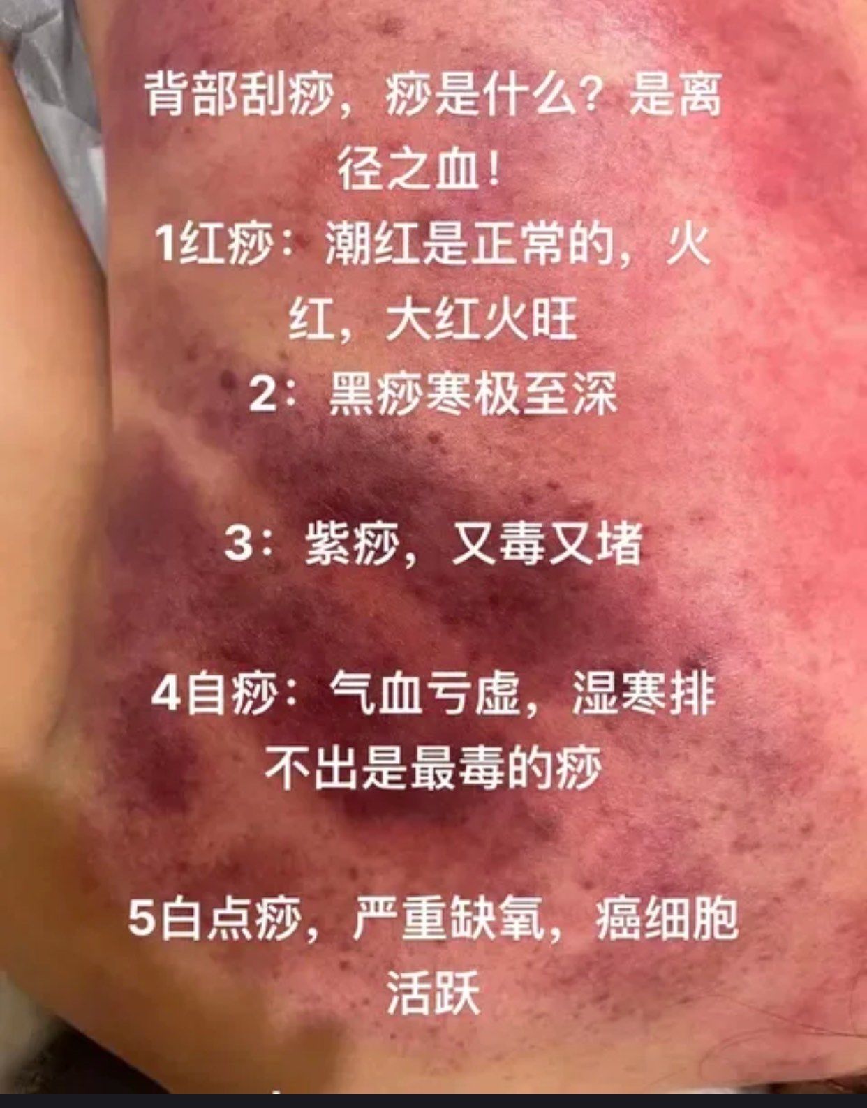 身体刮痧:看颜色看形状,了解身体健康状况