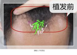 -大麦微针植发全国连锁