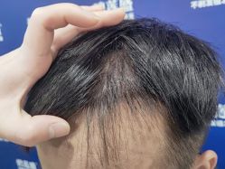 -碧莲盛·不剃发植发