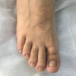 点击看大图 -德哥灰指甲脚气甲沟炎跖疣护理