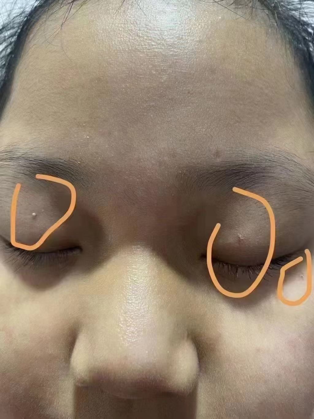 男性为什么长丝状疣