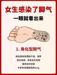 -德哥灰指甲脚气甲沟炎跖疣护理