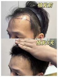 -碧莲盛不剃发植发