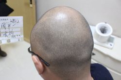 点击看大图 -大麦微针植发丨全国连锁