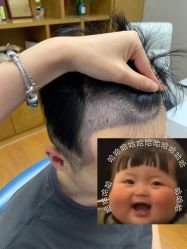 -大麦微针植发全国连锁