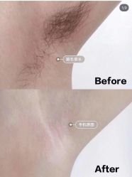 -薇兰专业脱毛连锁机构