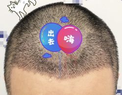 -大麦微针植发全国连锁