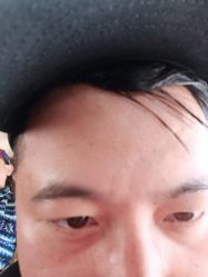 -爱莎扁平疣·汗管瘤·斑痣中心