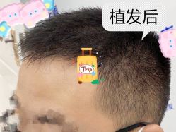 -大麦微针植发全国连锁