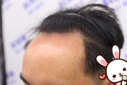 点击看大图 -大麦微针植发丨全国连锁