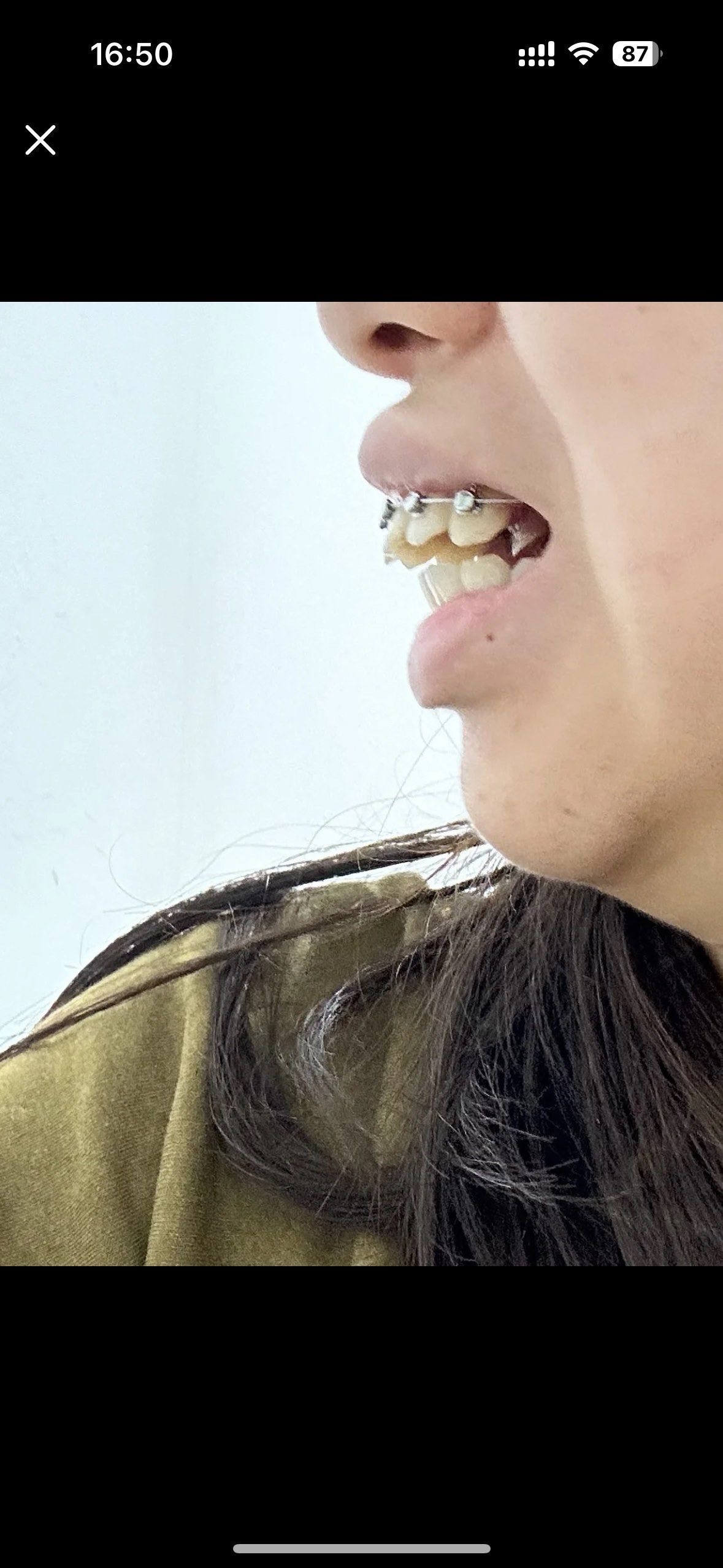 远看腿,近看嘴,牙齿不齐怎么美