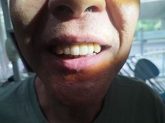 -上海仁爱医院口腔科 · 种植