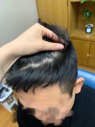 体验后-大麦微针植发全国连锁