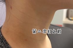 点击看大图 体验后-叶美人医疗美容