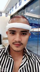 -大麦微针植发丨全国连锁