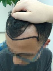 点击看大图 -大麦微针植发丨全国连锁