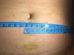 -肥三针腧穴瘦身馆