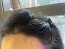 -碧莲盛·不剃发植发