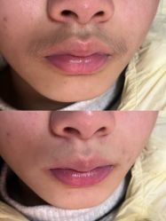 -薇兰专业脱毛连锁机构