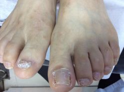 -德哥灰指甲脚气甲沟炎跖疣护理
