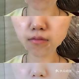Mediheal含针剂补水精华的面膜
