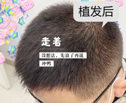 -大麦微针植发全国连锁