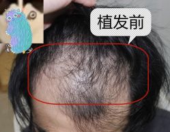 -大麦微针植发全国连锁