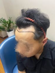 -大麦微针植发全国连锁