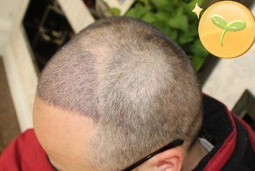 -大麦微针植发丨全国连锁