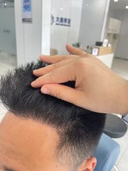 -大麦微针植发丨全国连锁