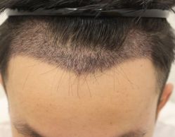 -大麦微针植发全国连锁