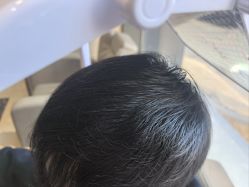 -碧莲盛·不剃发植发