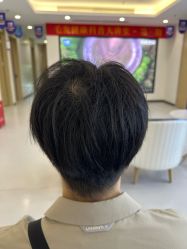 -大麦微针植发全国连锁
