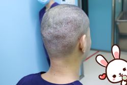 点击看大图 -大麦微针植发丨全国连锁