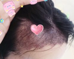 -大麦微针植发全国连锁