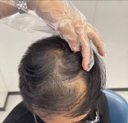 -大麦微针植发全国连锁