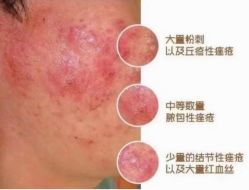 -苗方清颜专业祛痘连锁机构