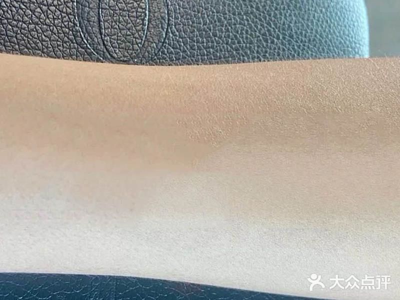 皮秒洗纹身