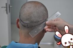 点击看大图 -大麦微针植发丨全国连锁