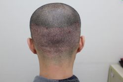 点击看大图 -大麦微针植发丨全国连锁