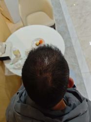 -大麦微针植发丨全国连锁