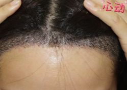 -大麦微针植发丨全国连锁