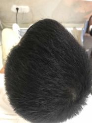 点击看大图 -大麦微针植发全国连锁