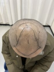 -大麦微针植发全国连锁